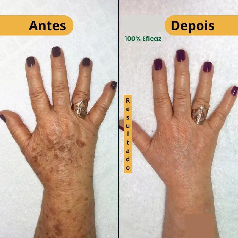 577-Spray Remove manchas de SOL, IDADE E MELASMA! 50% DE DESCONTO + FRETE GRÁTIS!