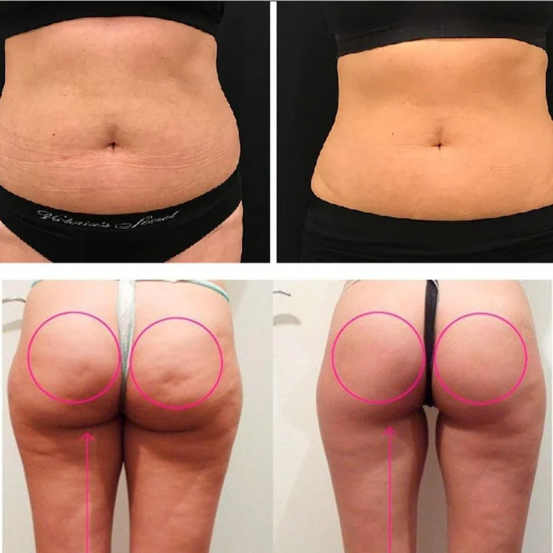 Aparelho Ultrassónico de Lipocavitação Estético/LipoLed