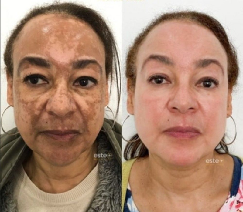 577-Spray Remove manchas de SOL, IDADE E MELASMA! 50% DE DESCONTO + FRETE GRÁTIS!