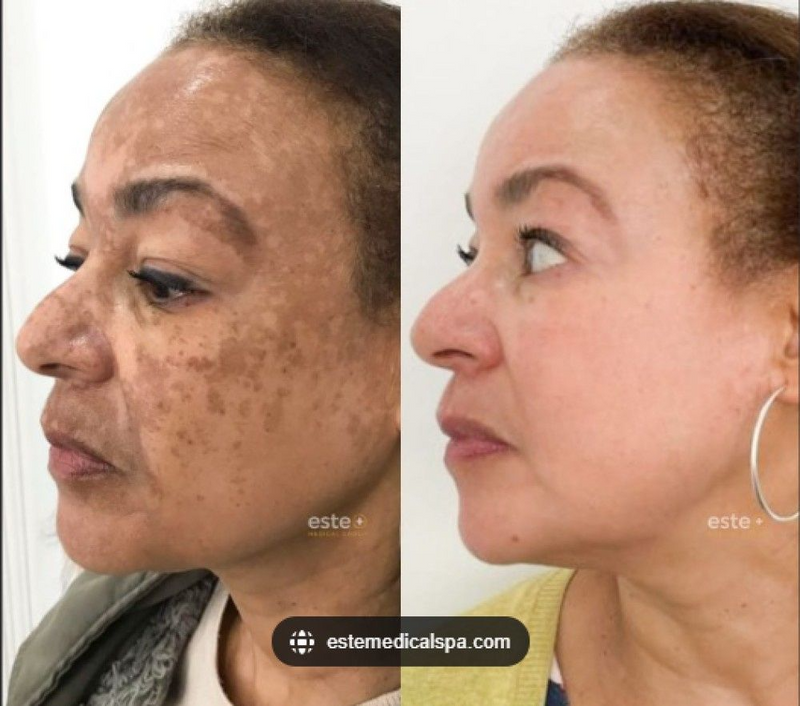 577-Spray Remove manchas de SOL, IDADE E MELASMA! 50% DE DESCONTO + FRETE GRÁTIS!