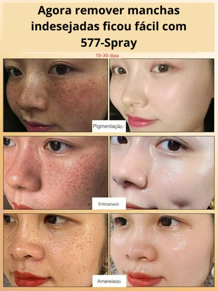 577-Spray Remove manchas de SOL, IDADE E MELASMA! 50% DE DESCONTO + FRETE GRÁTIS!