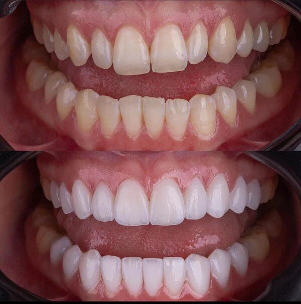 Facetas Odontológicas Removíveis | Sorriso Perfeito