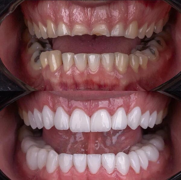 Facetas Odontológicas Removíveis | Sorriso Perfeito