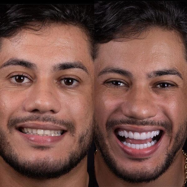 Facetas Odontológicas Removíveis | Sorriso Perfeito